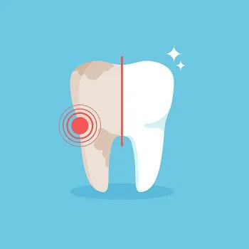 25973 at home teeth whitening