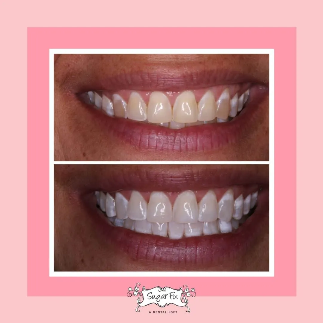 25974 foil teeth whitening process