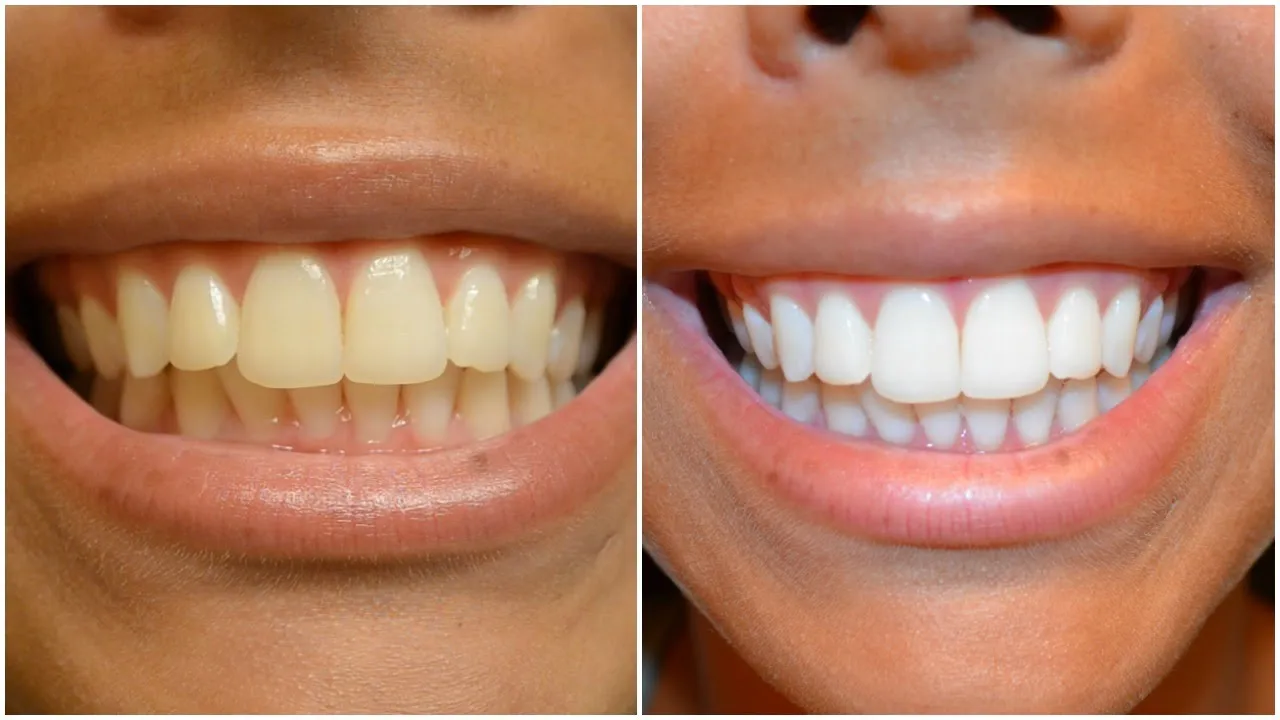 25981 whitening strips flexible strips