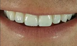 25982 teeth whitening columbia sc image3