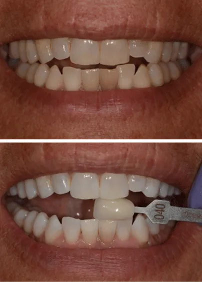 25982 teeth whitening columbia sc image5