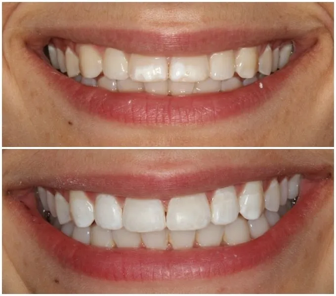 /img/25982-teeth-whitening-columbia-sc-image7.webp
