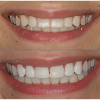 /img/25982-teeth-whitening-columbia-sc-image7.webp