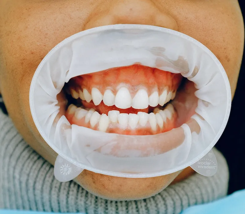 25986 teeth whitening before after