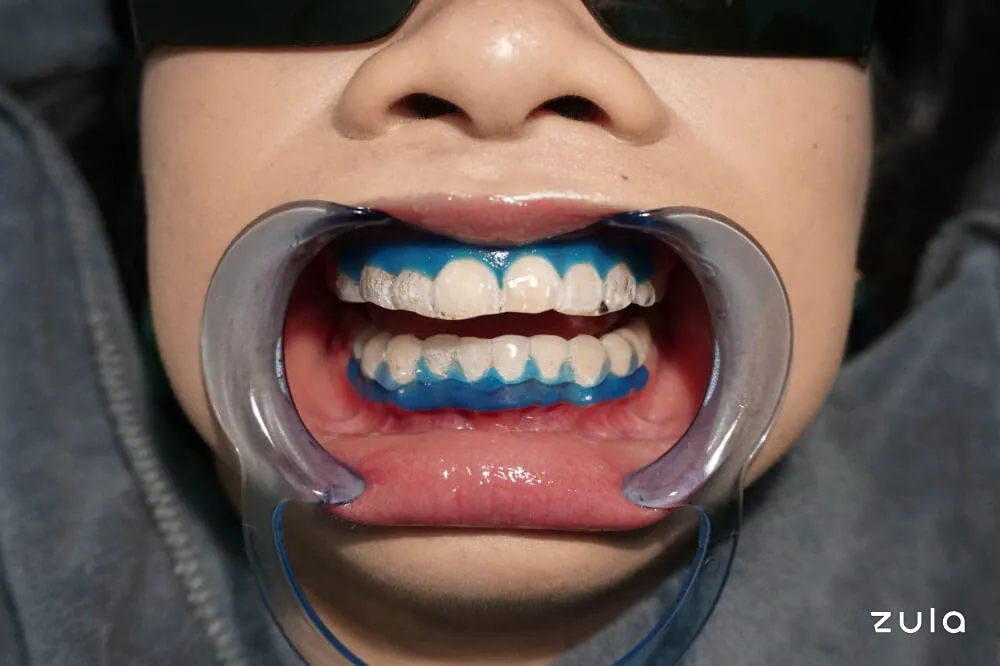 /img/25986-teeth-whitening-sensitivity.webp