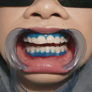 /img/25986-teeth-whitening-sensitivity.webp