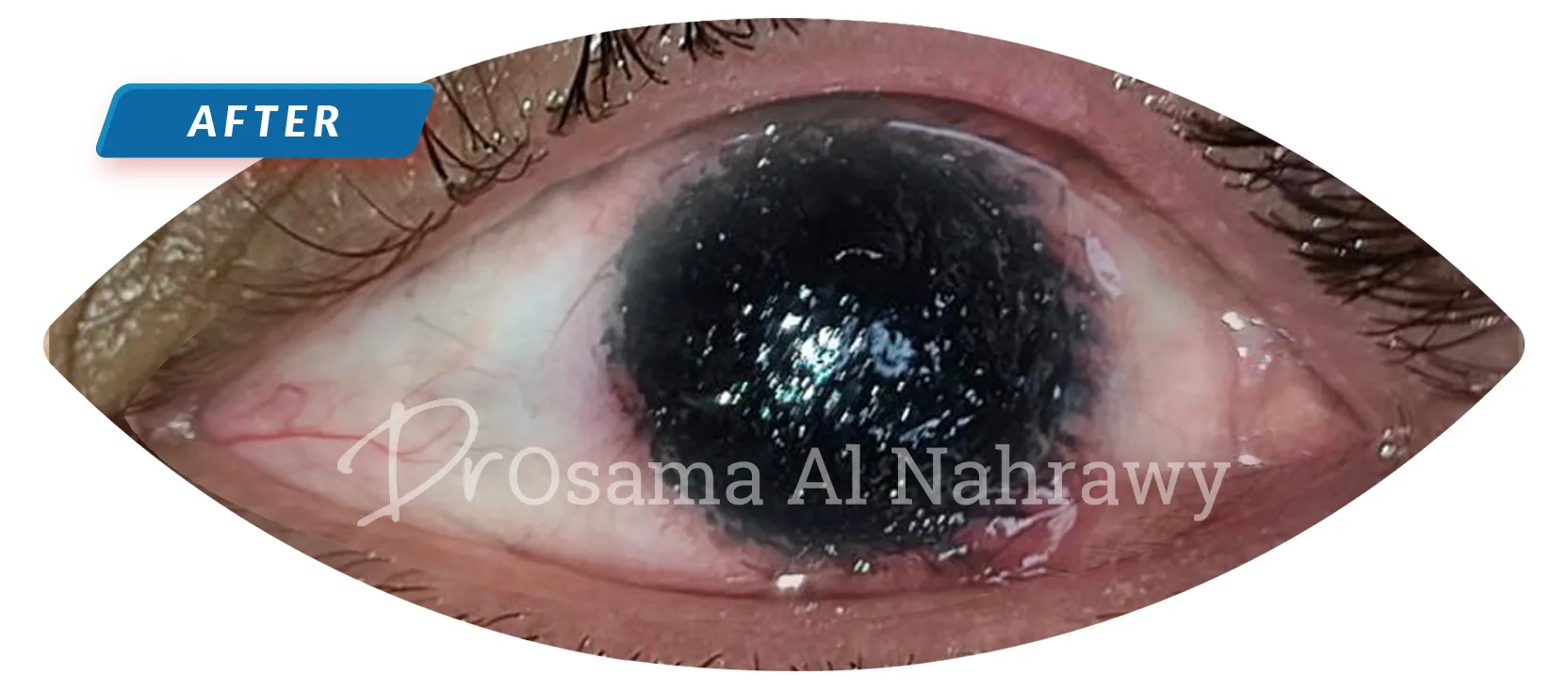 25989 cornea whitening image2