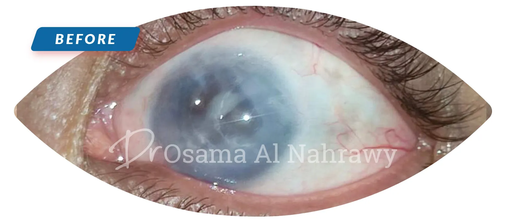 25989 cornea whitening image3