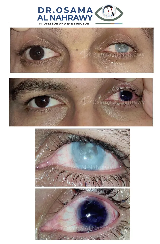 25989 cornea whitening image4