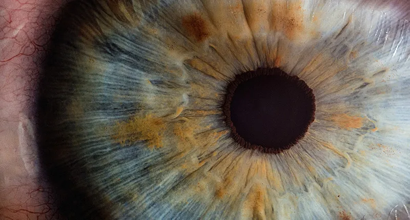 25989 cornea whitening image6