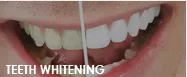 25991 teeth whitening maintenance
