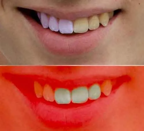 25995 teeth lasso tool