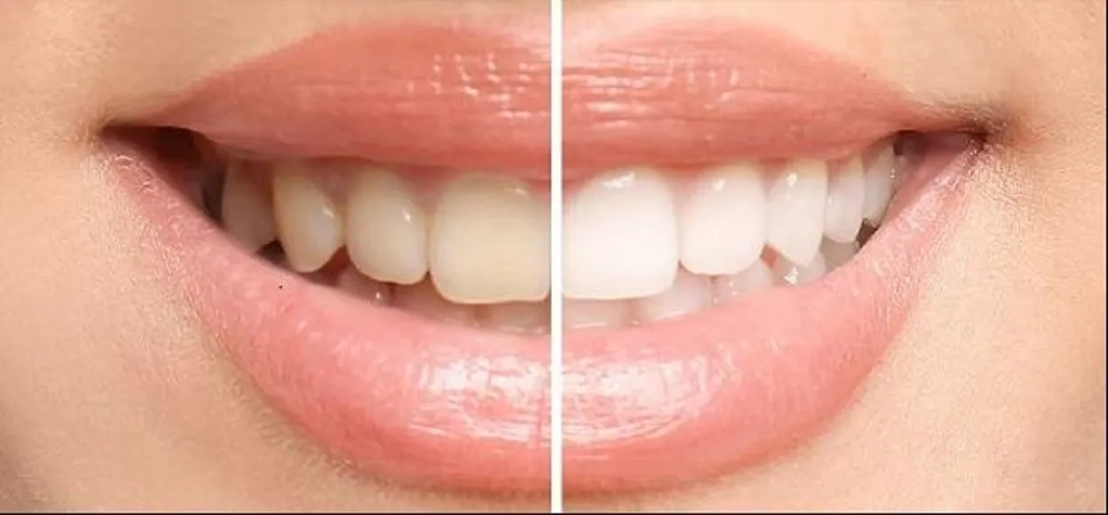 25995 teeth whitening before after