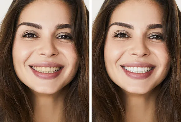 /img/25995-uneven-staining-teeth.webp