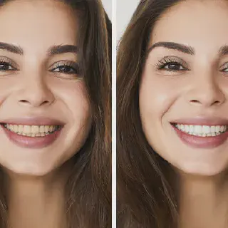 /img/25995-uneven-staining-teeth.webp