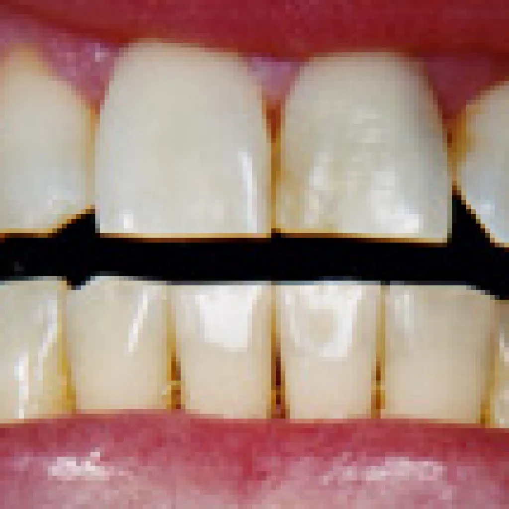25997 teeth whitening
