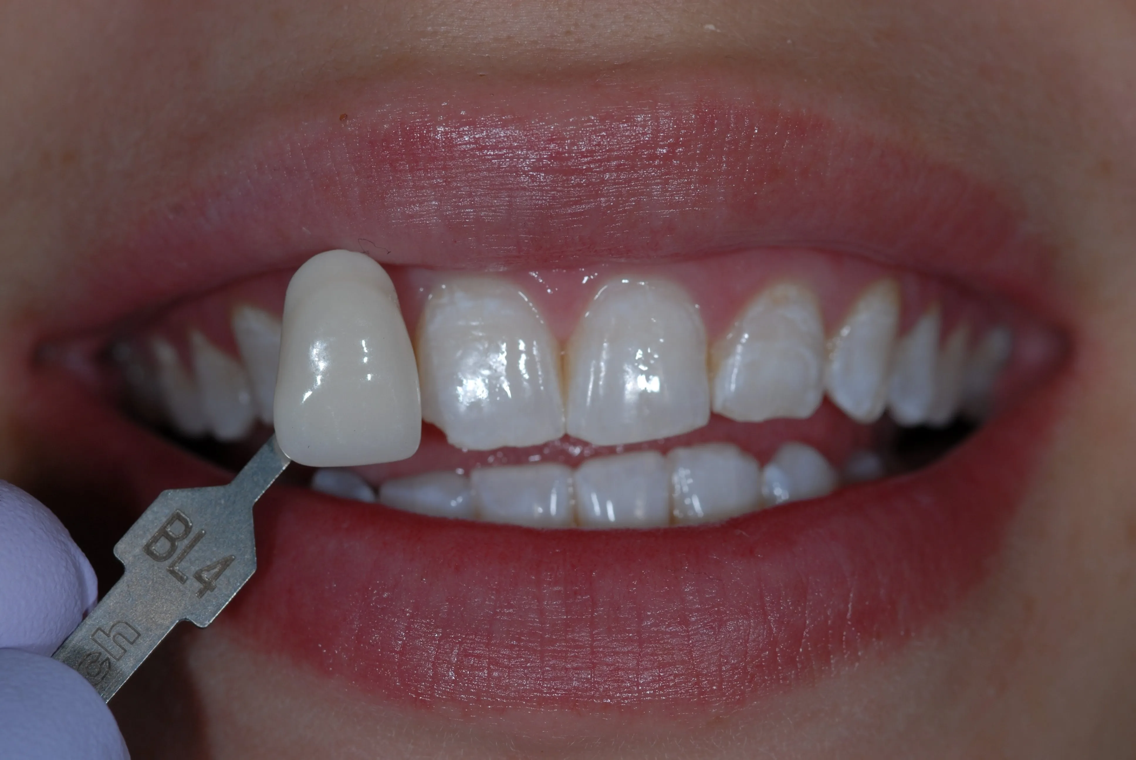 25998 bright smile maintenance
