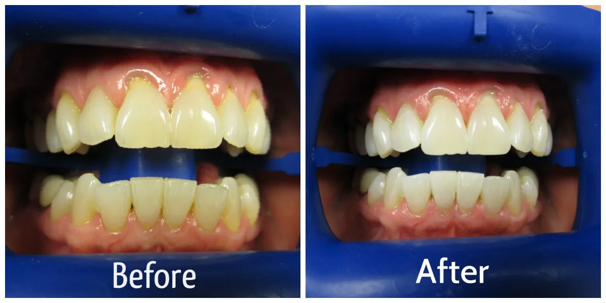 25998 whitening toothpaste