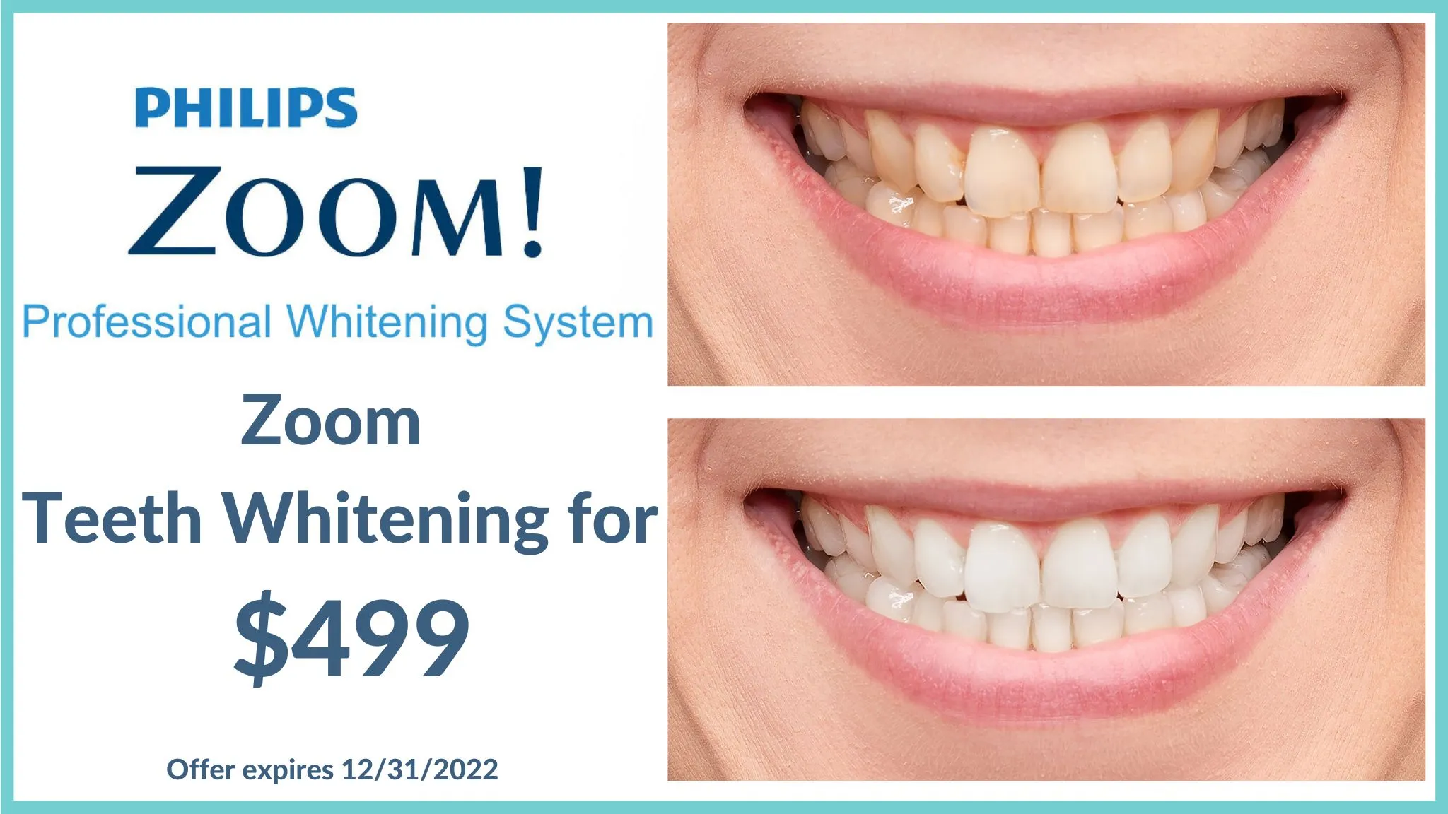 25998 zoom whitening results