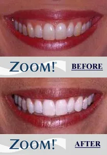 26005 zoom teeth whitening nyc 4