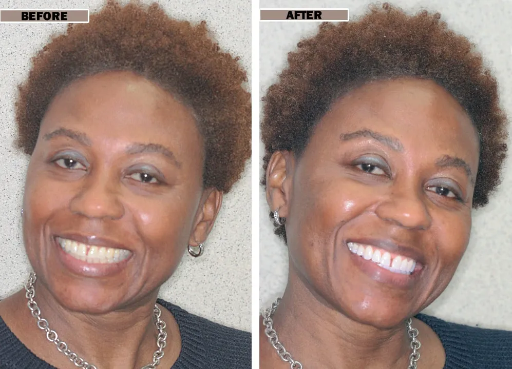 26005 zoom teeth whitening nyc 6