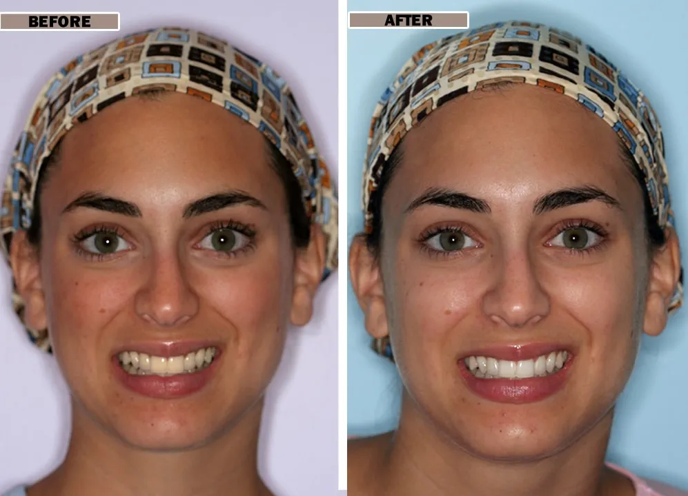 /img/26005-zoom-teeth-whitening-nyc-7.webp