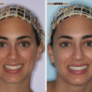 /img/26005-zoom-teeth-whitening-nyc-7.webp