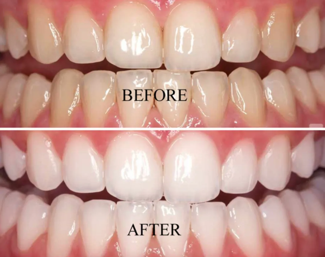 26009 gum irritation