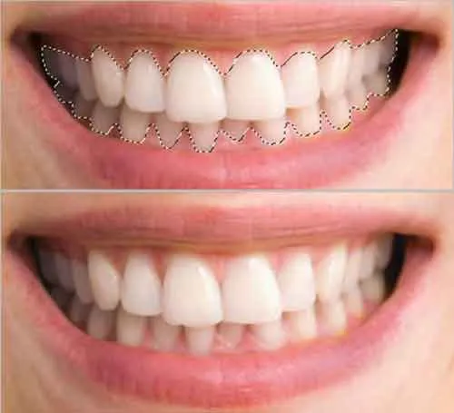 26011 before and after teeth whitening