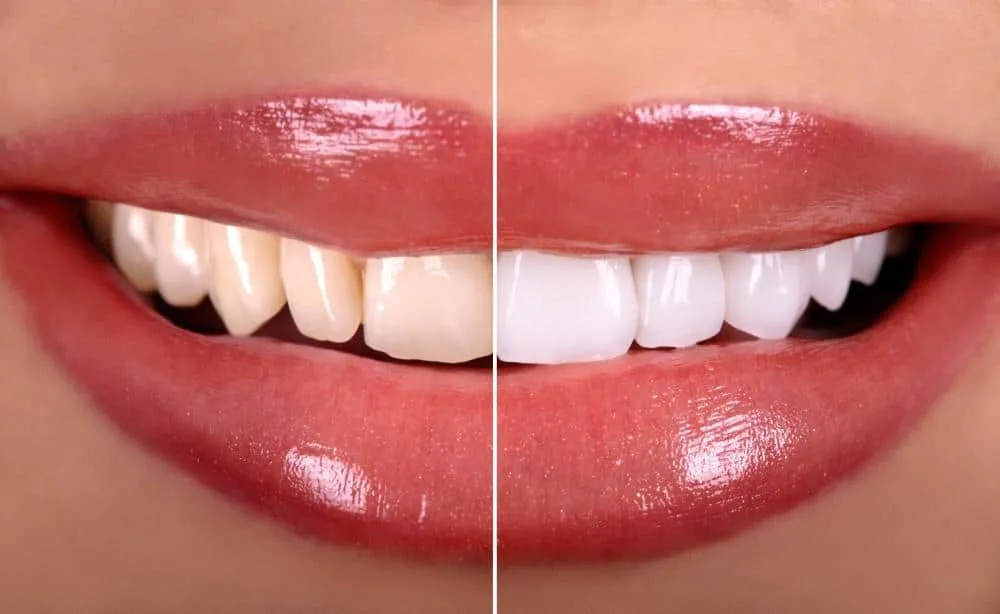 26013 fluoride treatment