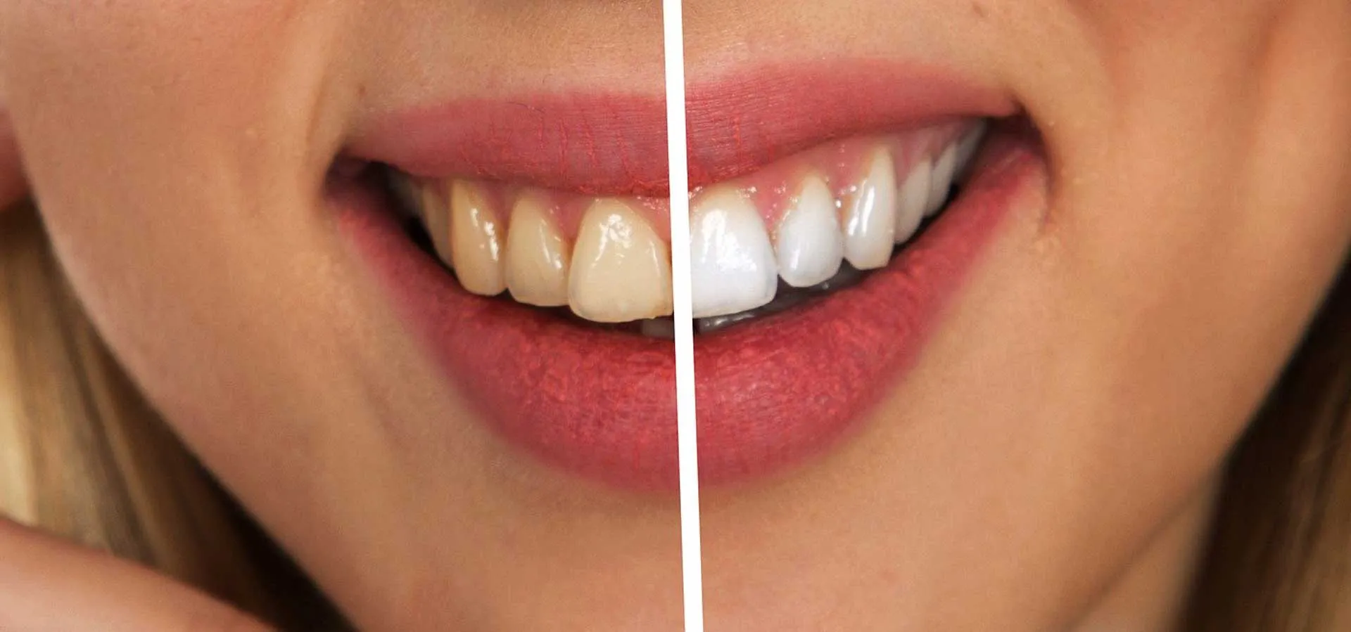 26013 tooth sensitivity