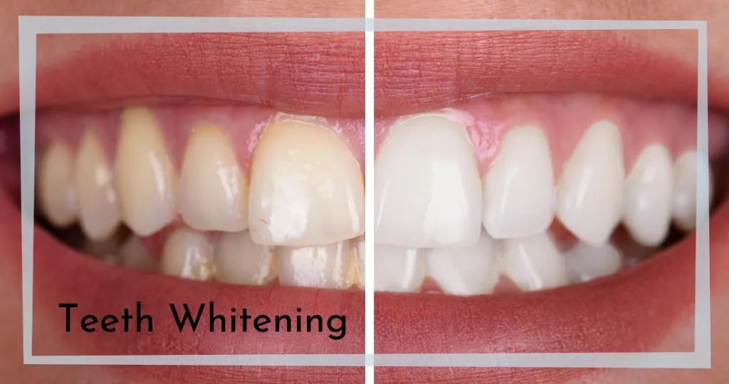 26018 teeth whitening bridgwater professional