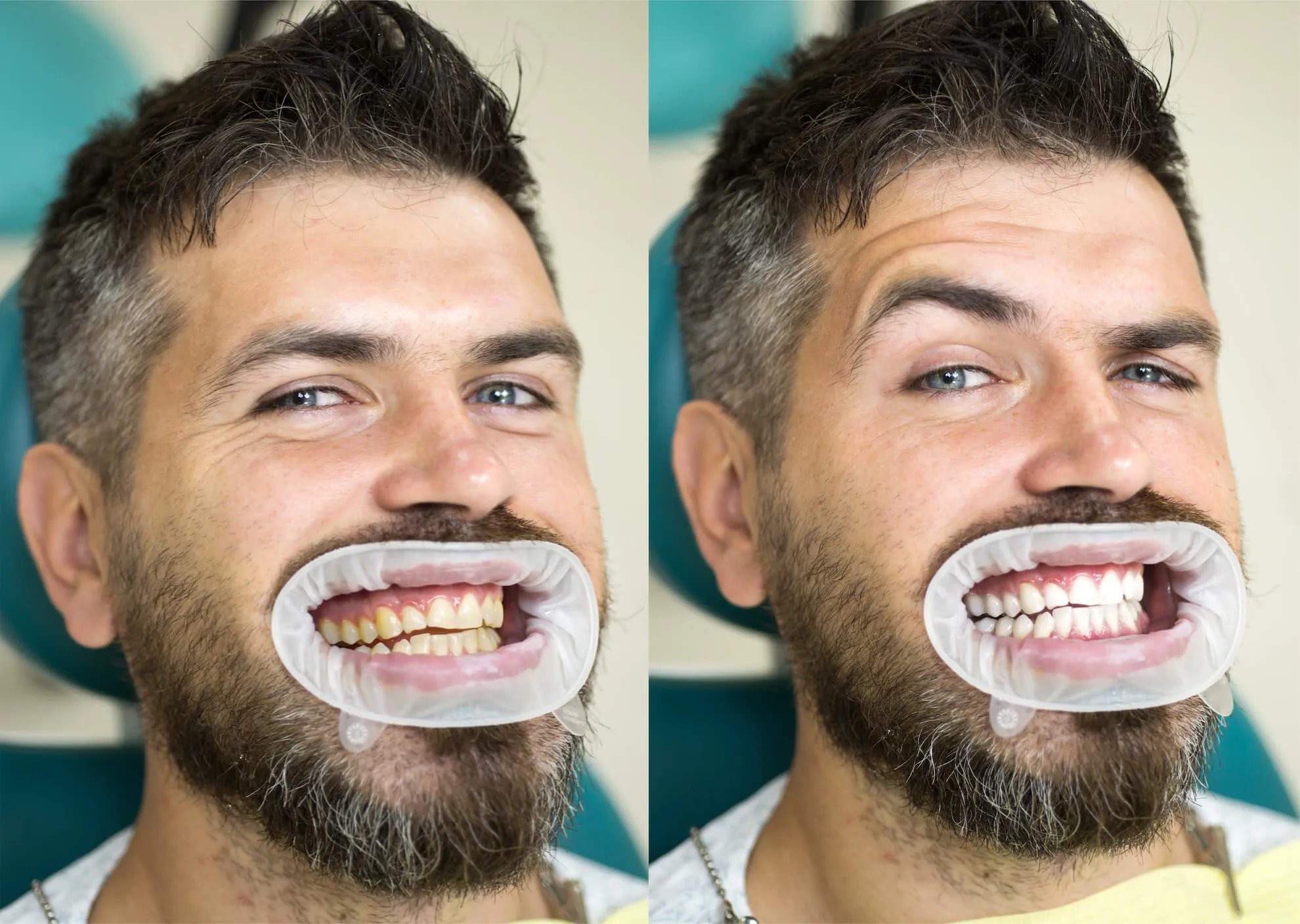 26018 teeth whitening bridgwater smile