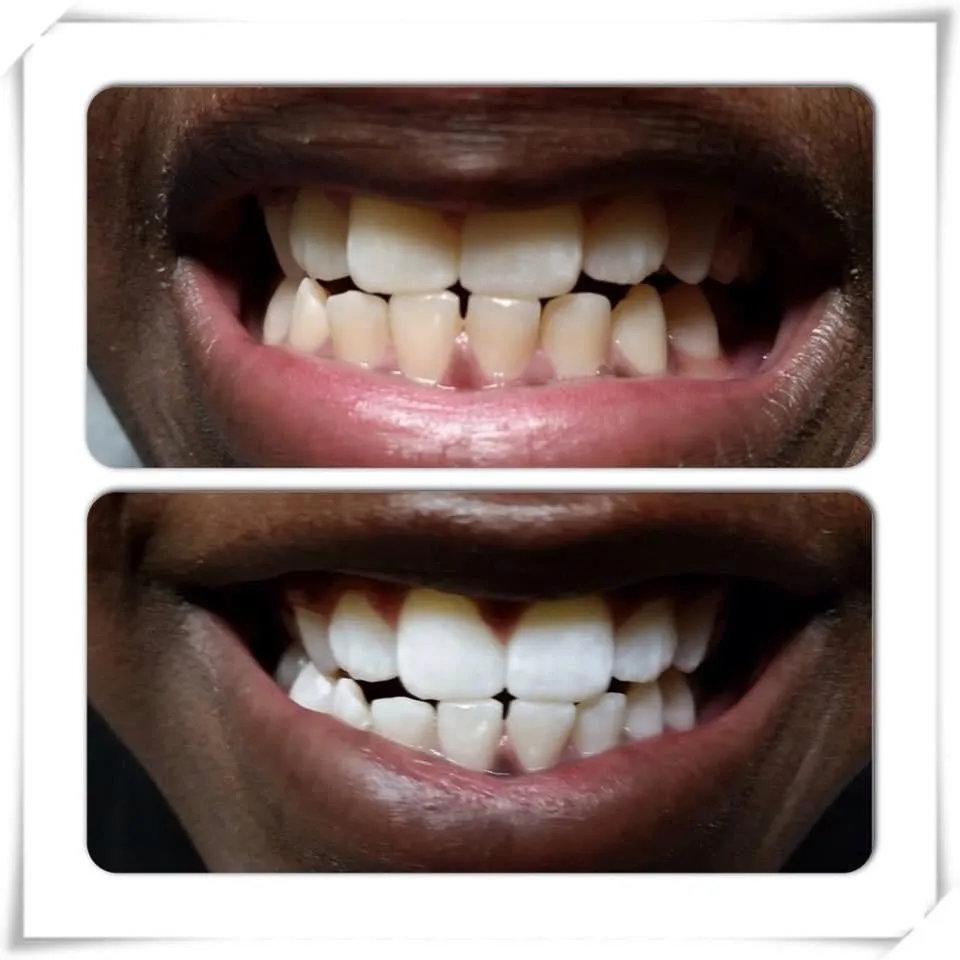 26021 in office teeth whitening