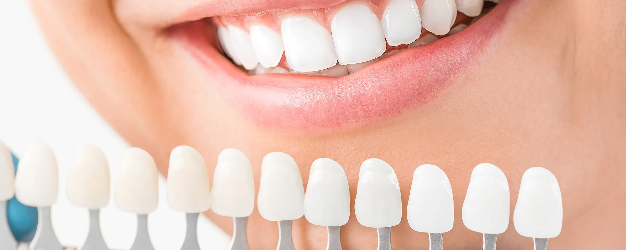 26021 teeth whitening procedures