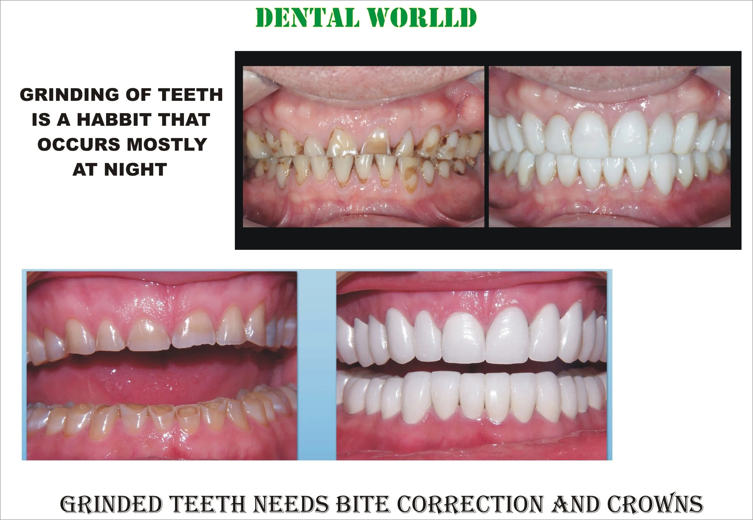 26022 sensitive teeth whitening