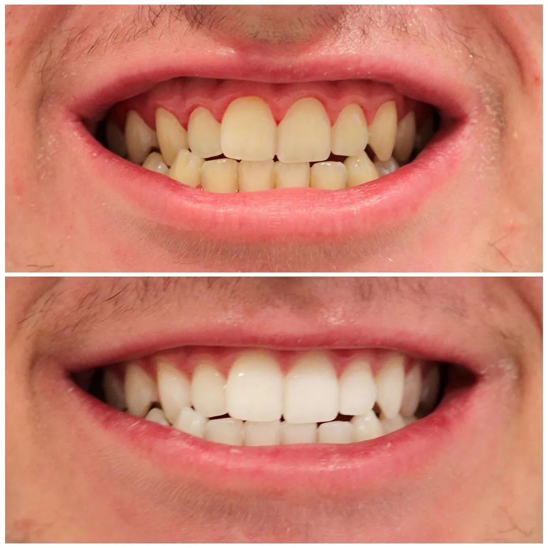 26025 at home whitening kits