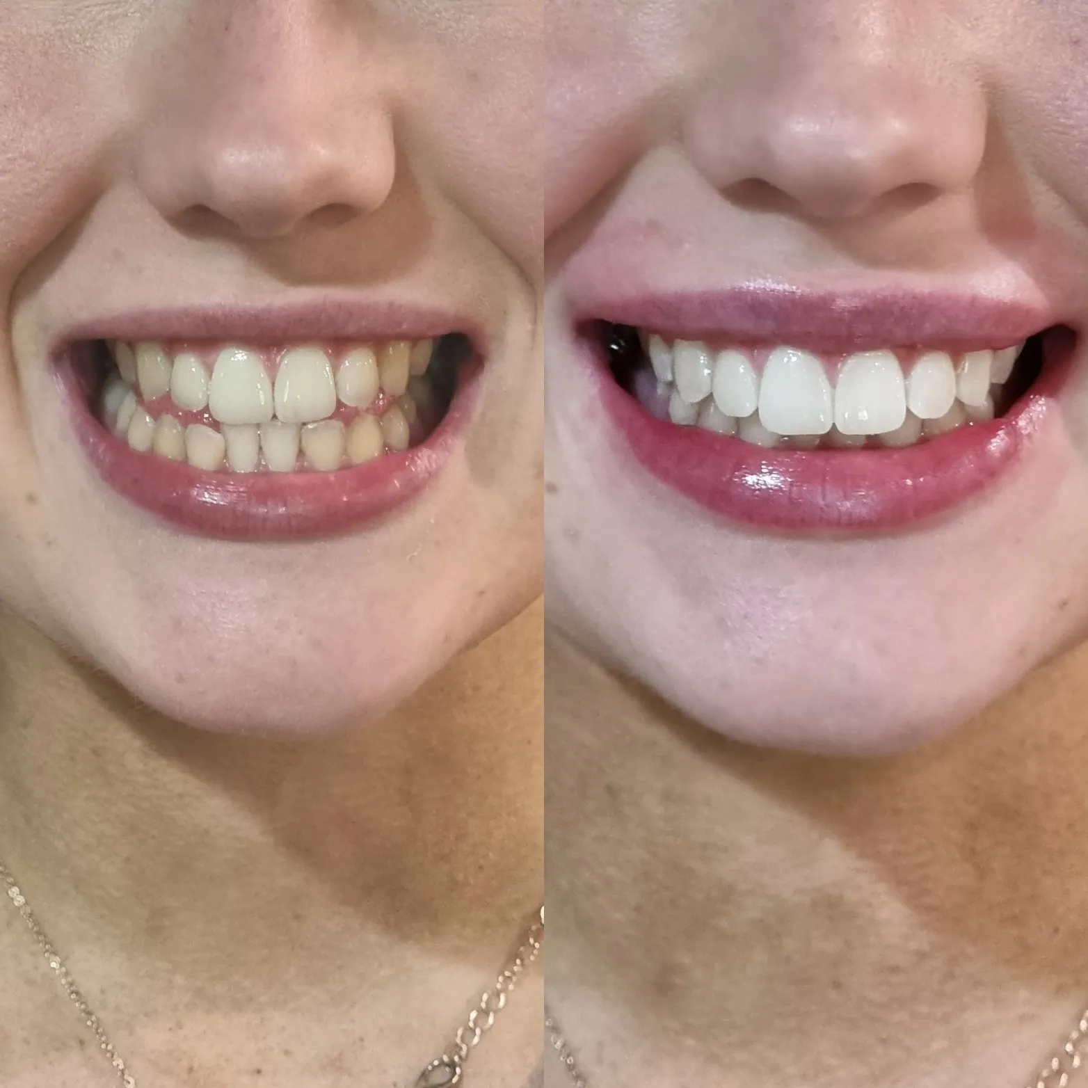 26028 teeth whitening melbourne 2