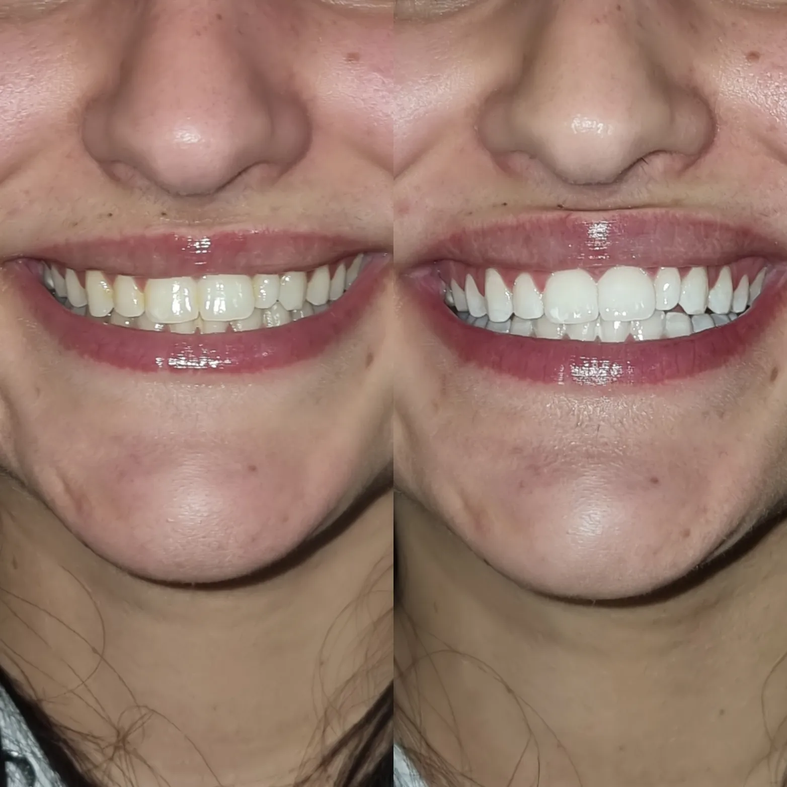 26028 teeth whitening melbourne 4
