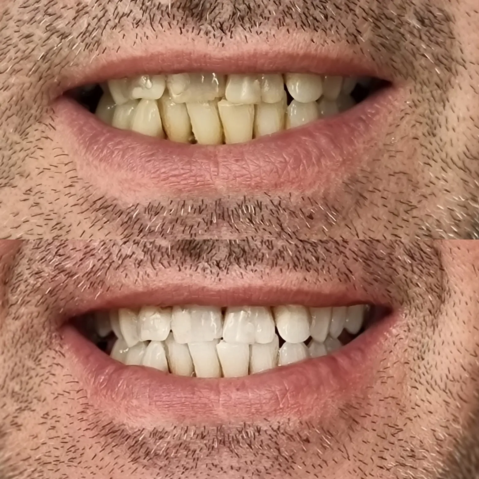 26028 teeth whitening melbourne 5