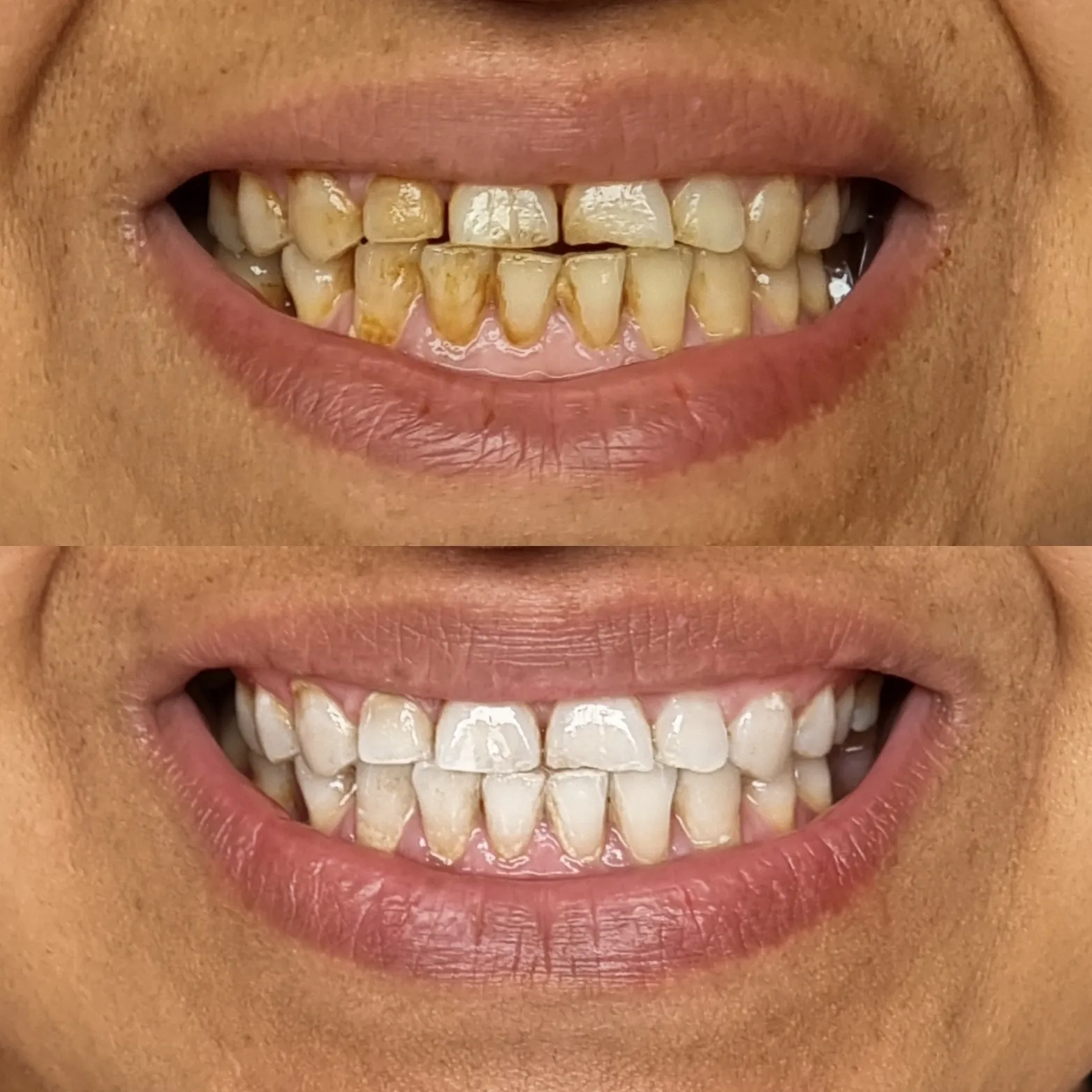 /img/26028-teeth-whitening-melbourne-7.webp