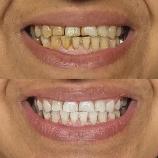 /img/26028-teeth-whitening-melbourne-7.webp