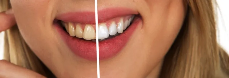 26029 teeth whitening hurts gums image2