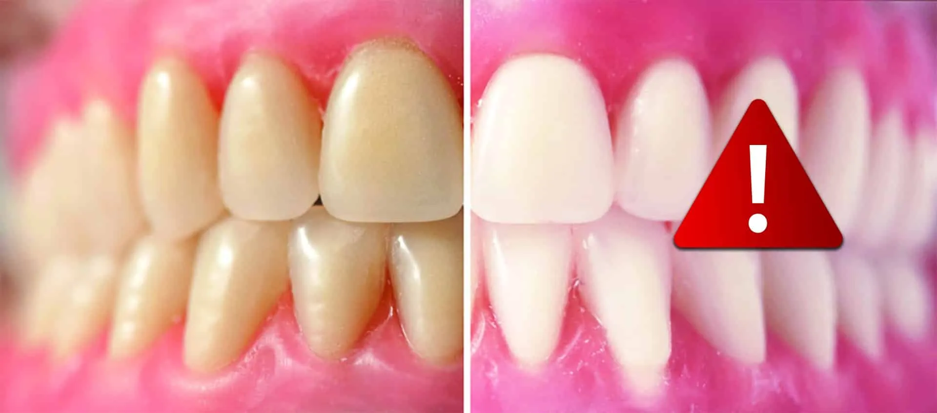 26029 teeth whitening hurts gums image5