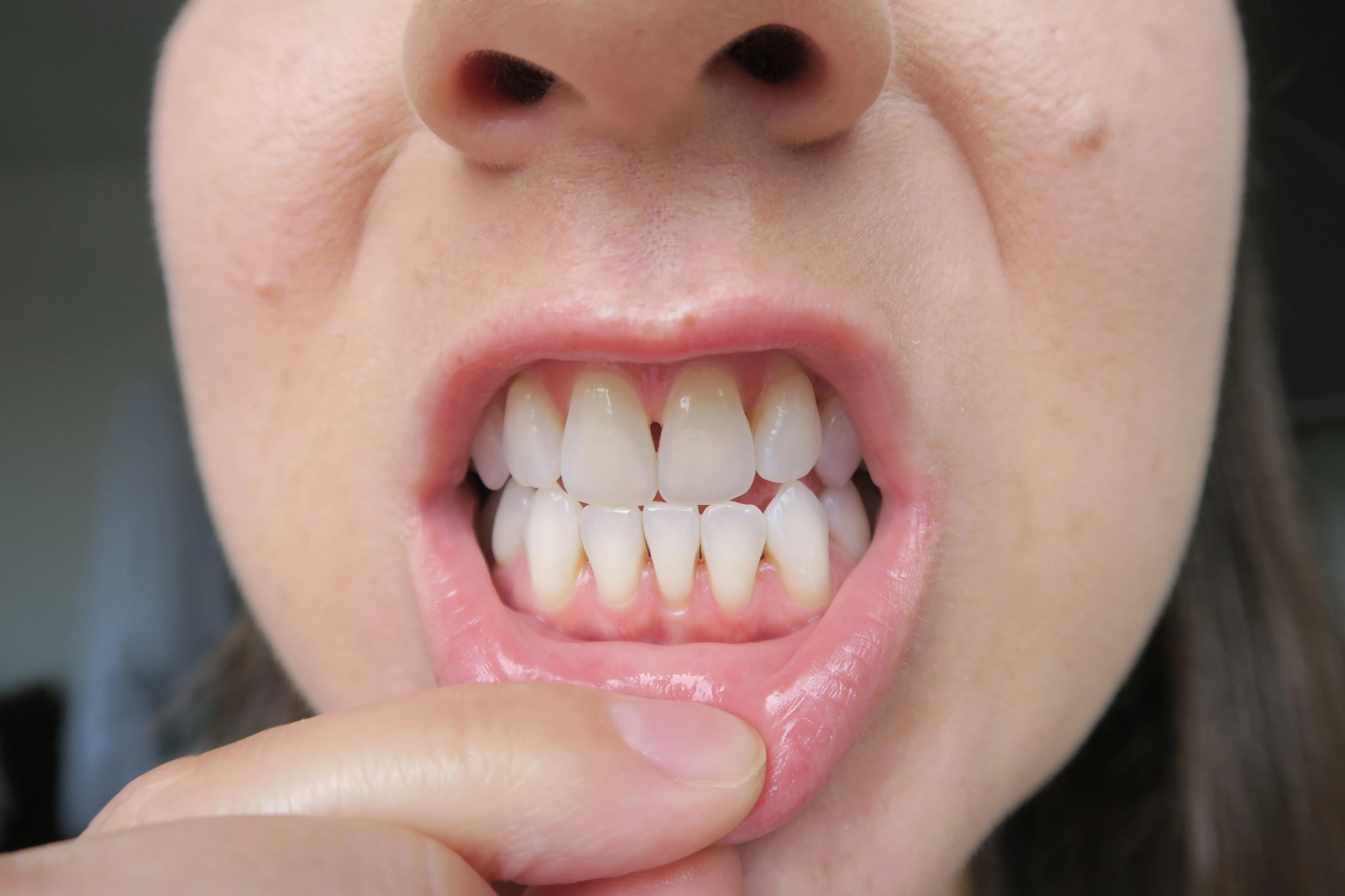 /img/26029-teeth-whitening-hurts-gums-image7.webp