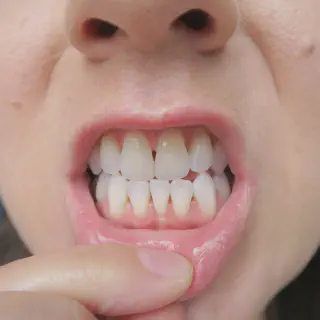 /img/26029-teeth-whitening-hurts-gums-image7.webp