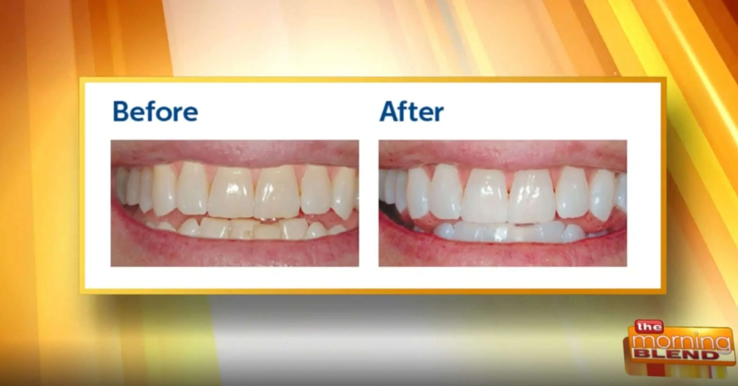 26030 dentist teeth whitening cost