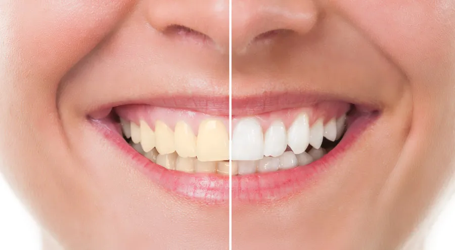 26030 dentist teeth whitening procedure