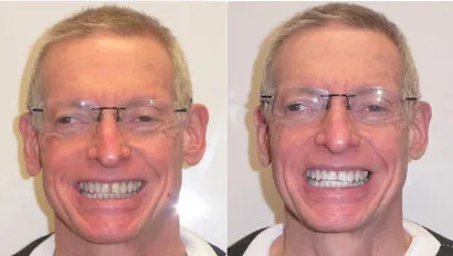 26032 zoom teeth whitening aftercare 1