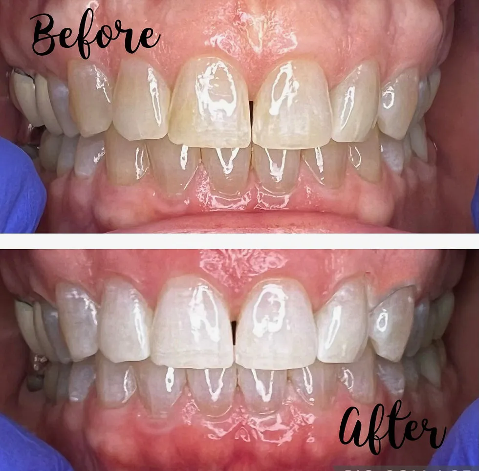 26032 zoom teeth whitening aftercare 4